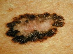 EUROMELANOMA DAY