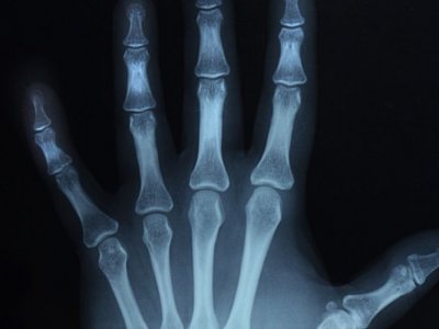 Kako možemo spriječiti ili ublažiti osteoporozu?