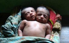 U Bangladešu roden djecak s dvije glave
