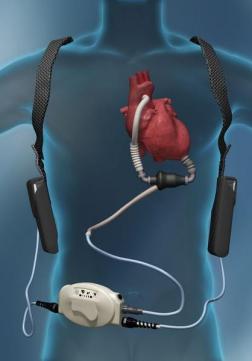 Na KB Rebru prvi su put ugradili mehaničko srce