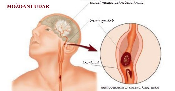 PRVA NAJAVA MOŽDANOG UDARA