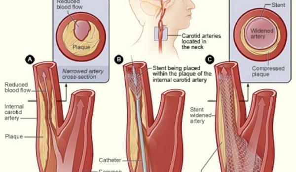 10 nаmirnicа kоје odčepljuju arterije na potpuno prirodan način