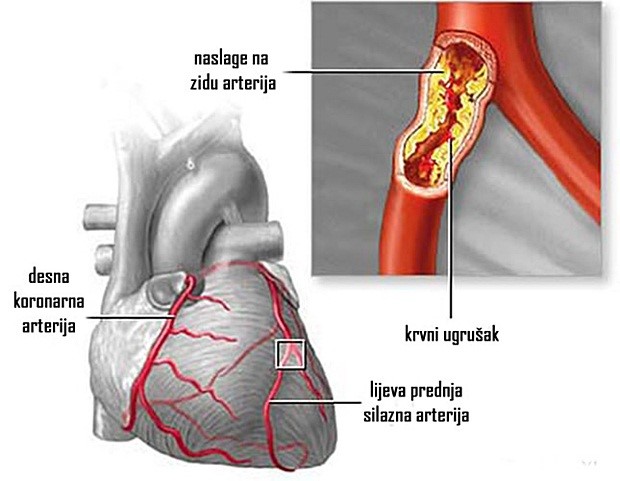 Ove tri namirnice RAZBIJAJU zakrčenja arterija i masnoću u krvi