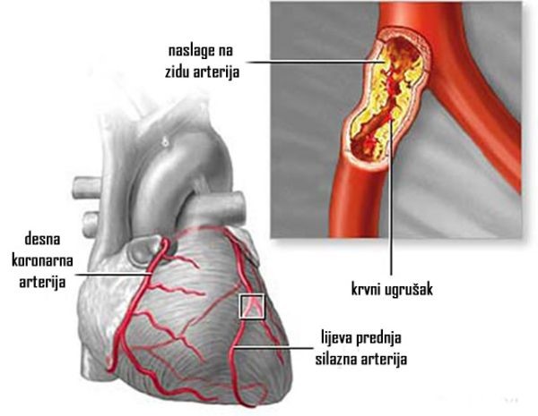 Sačuvajte srce, mozak i bubrege: Očistite arterije sa samo 3 sastojka