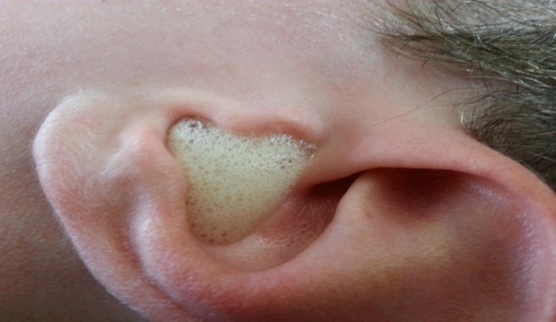 Ovo je najbolji način da očistite uši i riješite se upale uha!