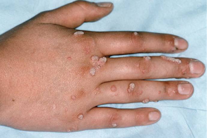 PROVJERENI PRIRODNI LIJEKOVI - BRADAVICE