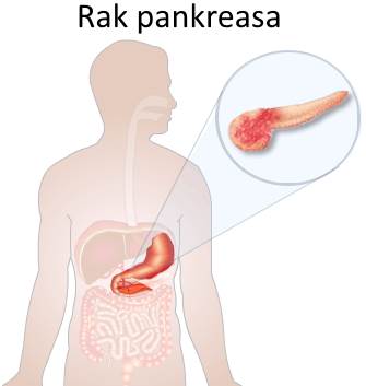 Lečenje neizlečivih bolesti - Rak pankreasa