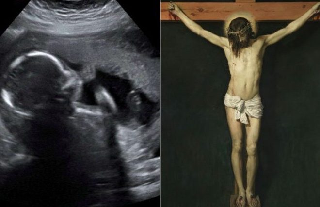 FOTO ZAČUĐUJE SVIJET Trudnica htjela napraviti abortus, tad je ultrazvuk pokazao OVO
