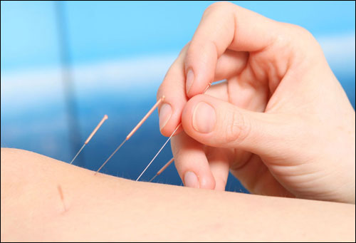 Akupunktura ublažava bol