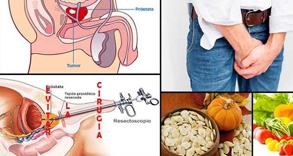 RAZNI PRIRODNI RECEPTI ZA ZDRAV ŽIVOT - ZA OBOLELU PROSTATU