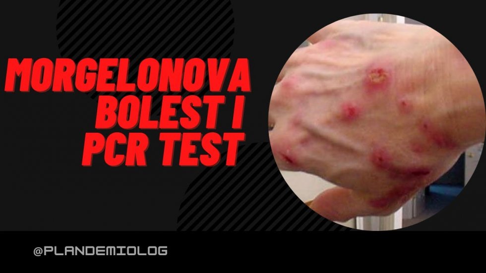 MORGELONOVA BOLEST I PCR TEST