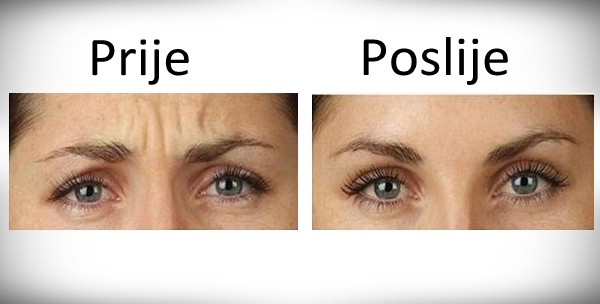 Botox histerija!
