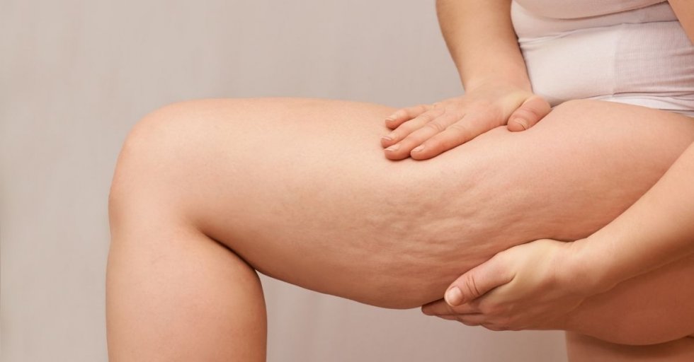 Vjerovali ili ne: Celulit ’91. - 100 godina celulita