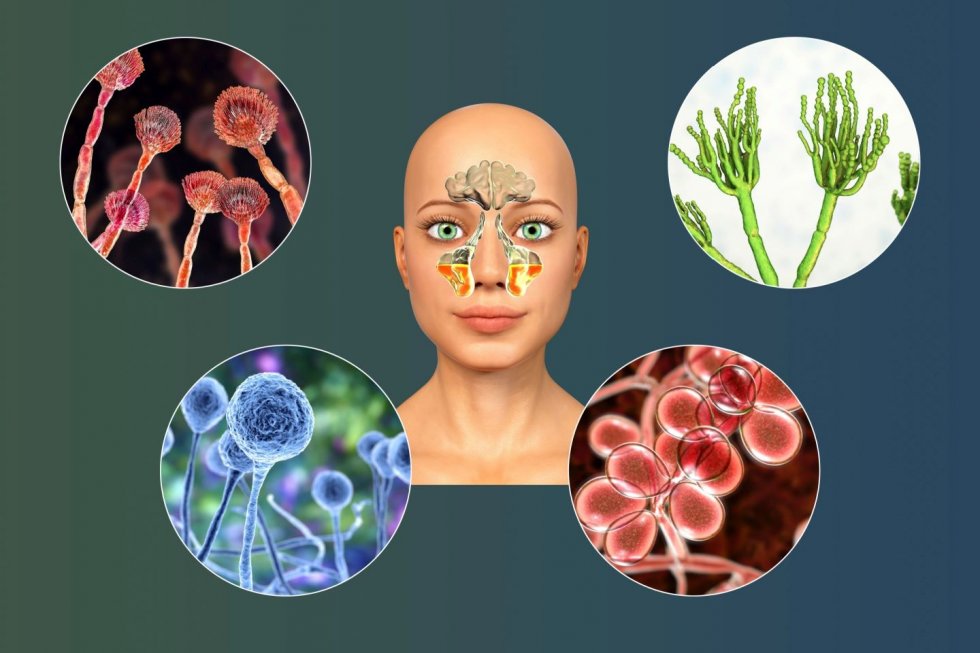 3)Gljivične infekcije