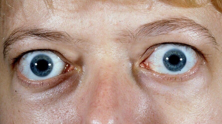 Endokrina orbitopatija