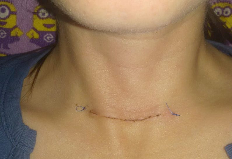 Operacija štitne žlezde