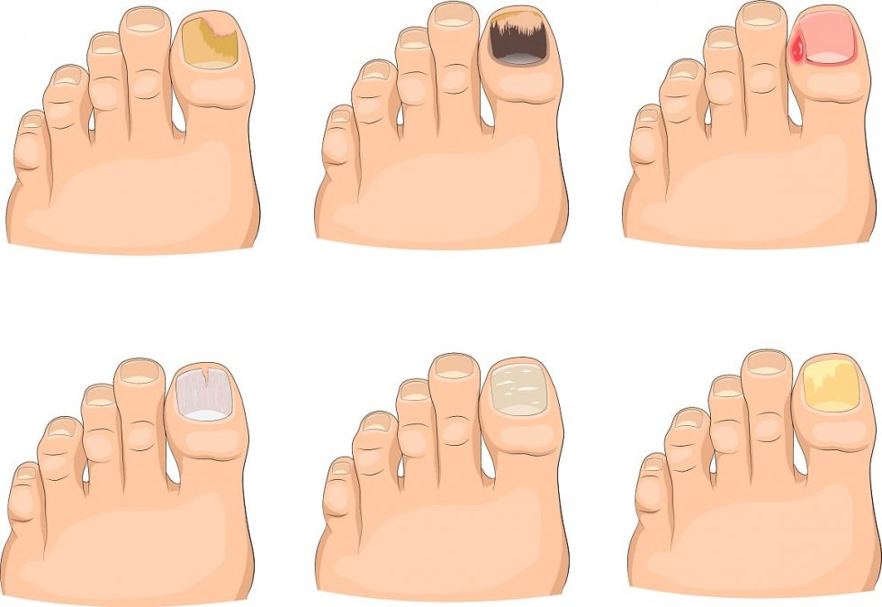 ANOMALIJE I DEFORMACIJE NOKTA I STOPALA