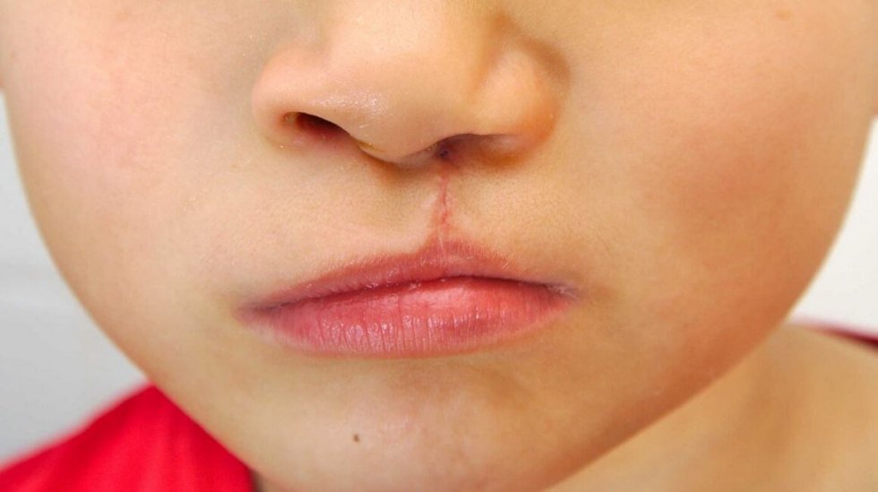 Zečja usna: uloga gena veća je nego se mislilo