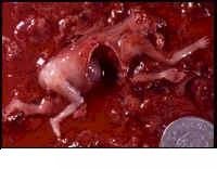 abortirani fetus star 11 tjedana