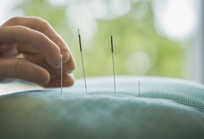 Što je akupunktura?: Otkrivanje drevnog liječenja u modernim vremenima