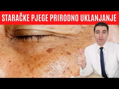 Za Starije: Staračke Pege Nestaju ZAUVEK Kada Natrljate OVO